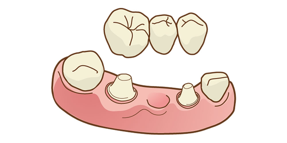 ブリッジ治療