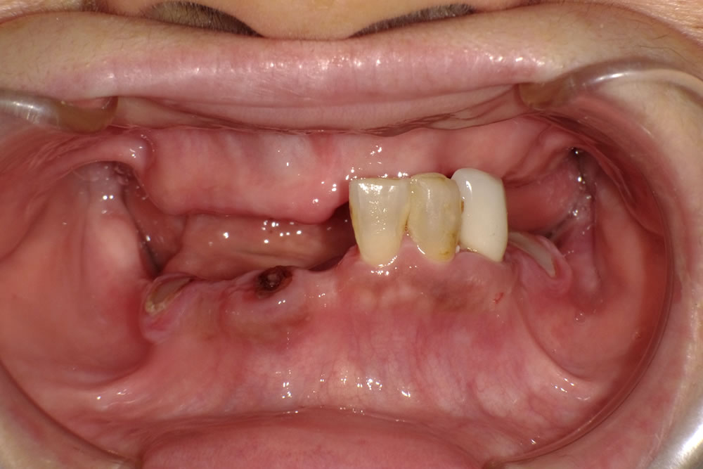 ミラクルデンチャー治療前