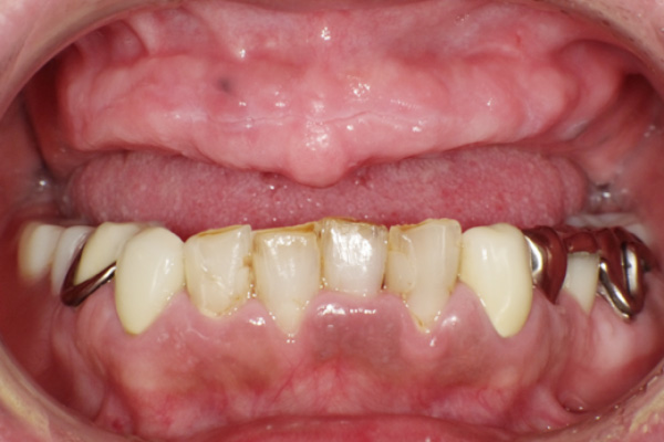 金属床の総義歯治療症例